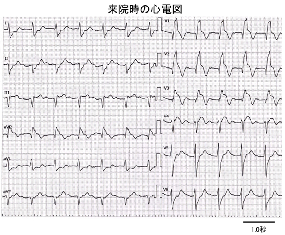 来院時の心電図