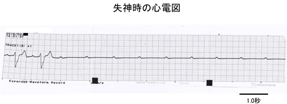 失神時の心電図