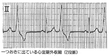 心室期外収縮（二段脈）