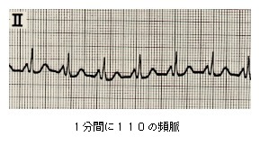 1分間に110の頻脈