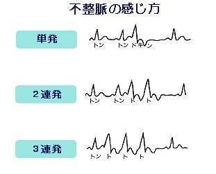 不整脈の感じ方