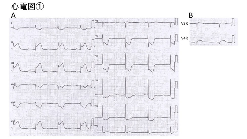 心電図①