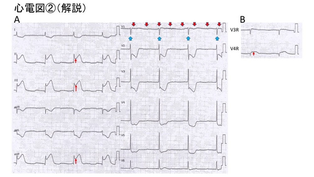 心電図②