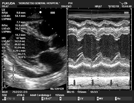 心エコー図3