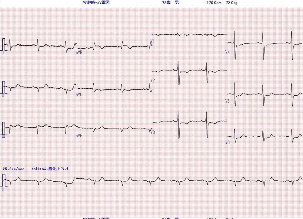 心電図１