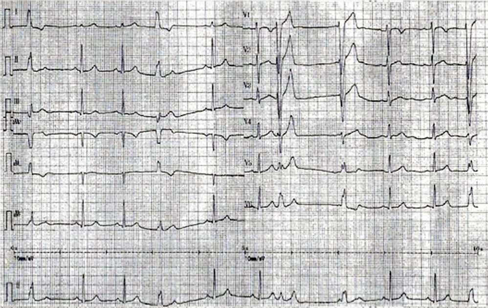 心電図１前医で記録された12誘導心電図