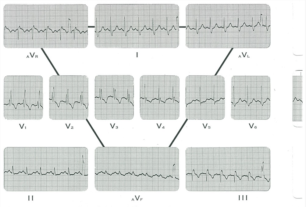  心電図3