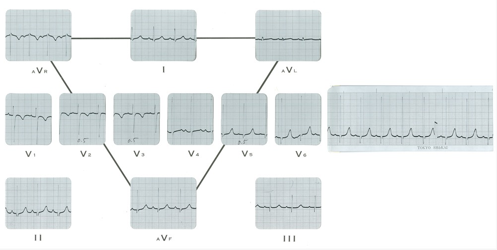 心電図1