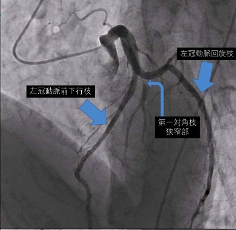 左冠動脈造影１（左前斜位頭側像）
