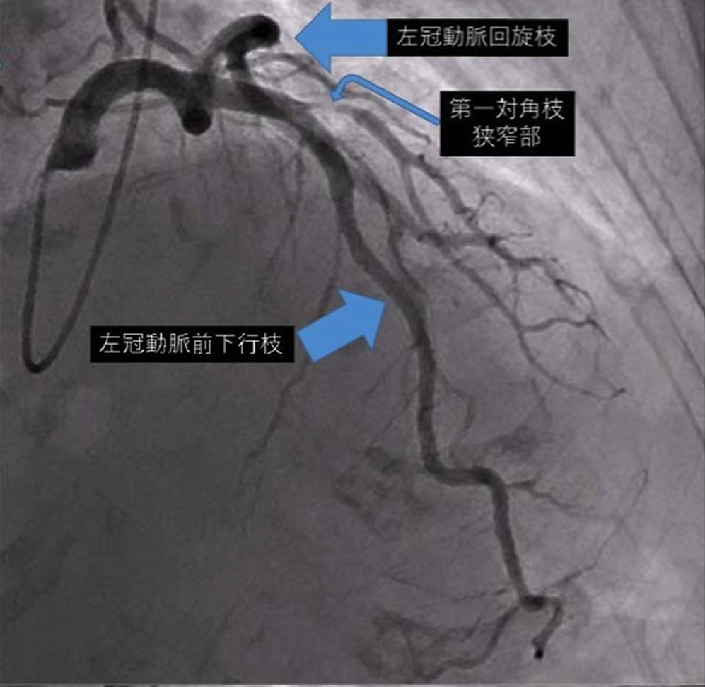  左冠動脈造影２（右前斜位頭側像）