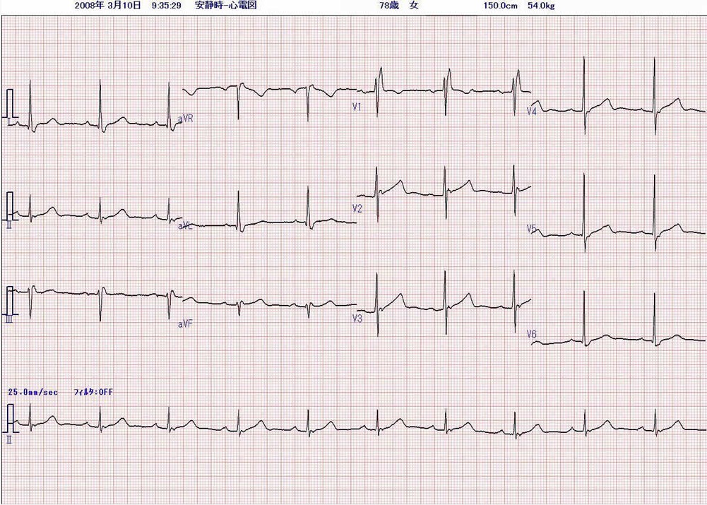 図４　8年前に記録された心電図
