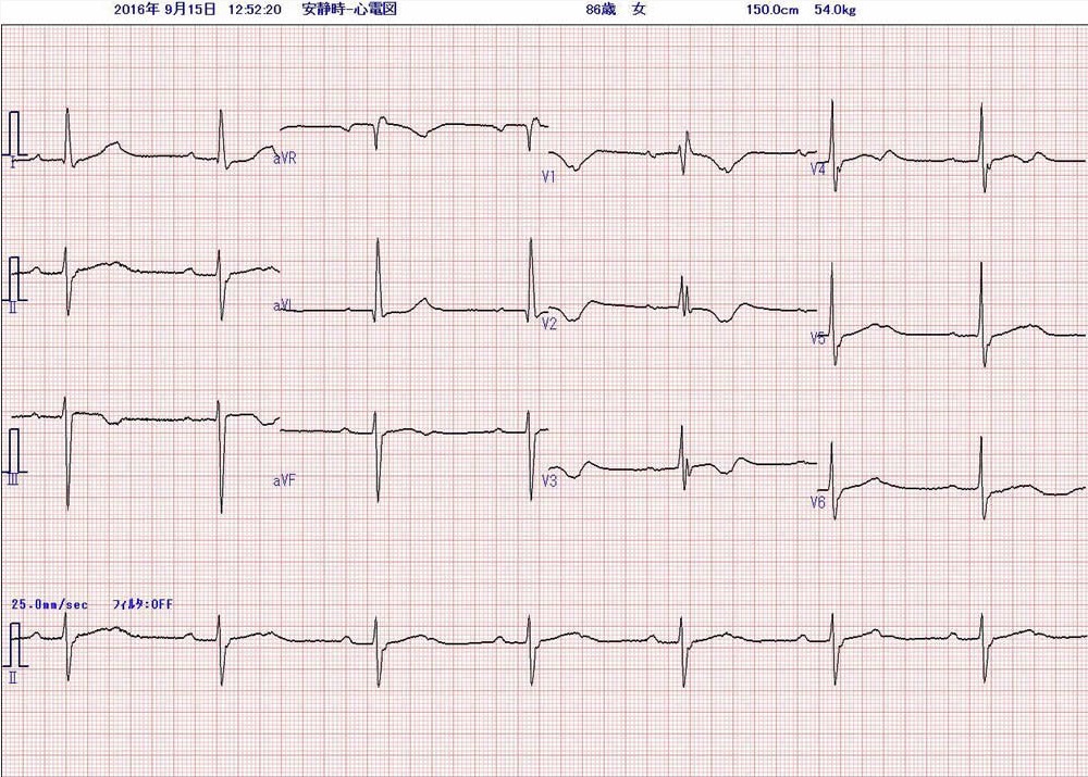 心電図1　来院時の心電図