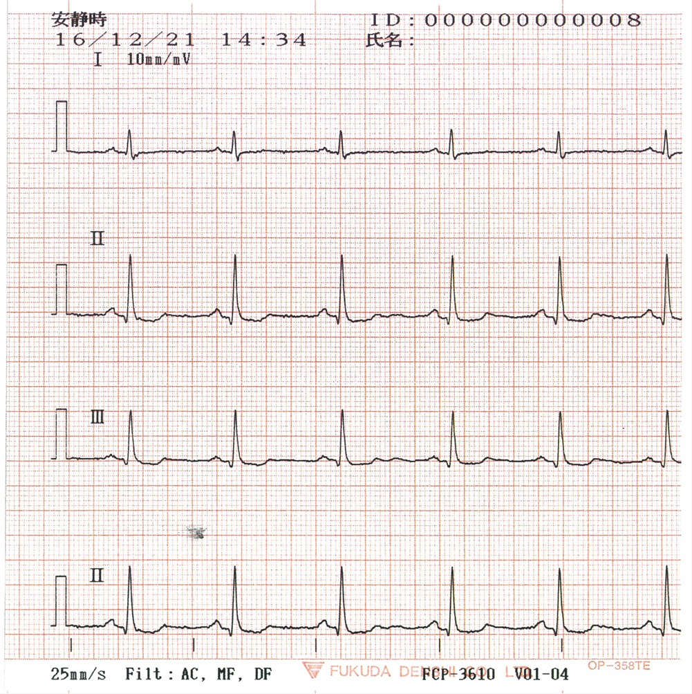 心電図①