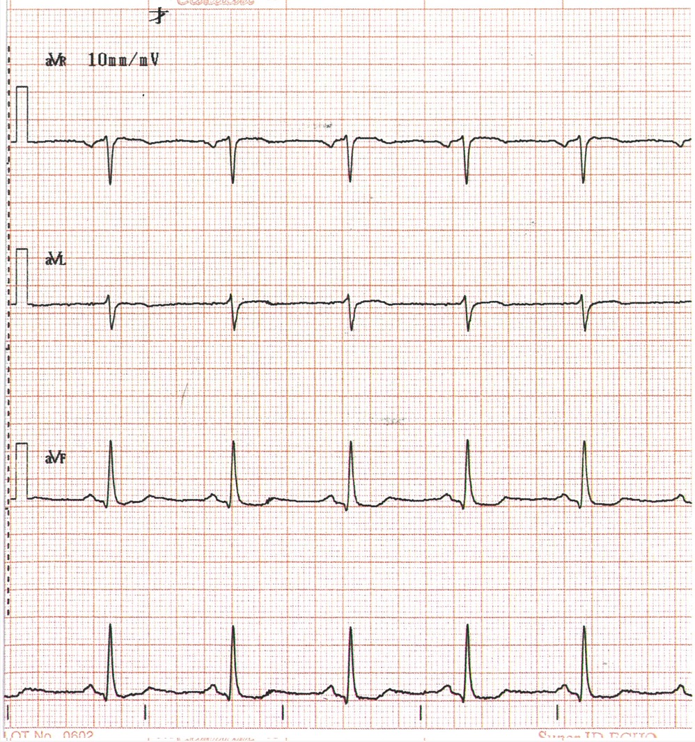 心電図②
