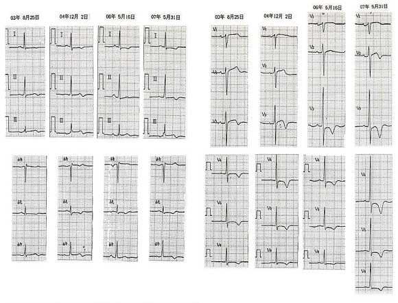 心電図　時系列