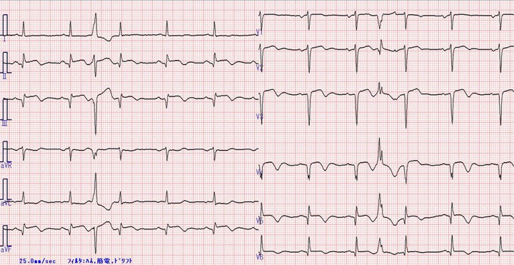 症例21 9年前に急性心筋梗塞を発症 公益社団法人 臨床心臓病学教育研究会（ジェックス）
