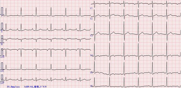3年前の心電図