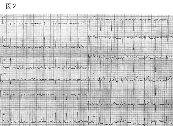 右側胸部誘導で記録した心電図