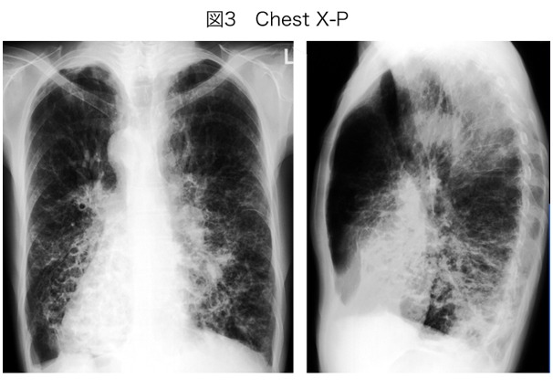 図3 胸部レントゲン写真