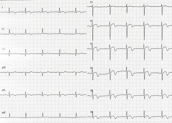2日後の心電図