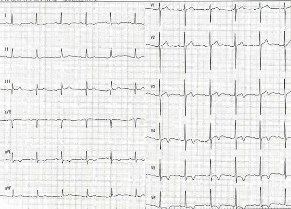 2ヶ月後の心電図