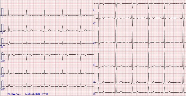 半年前の心電図