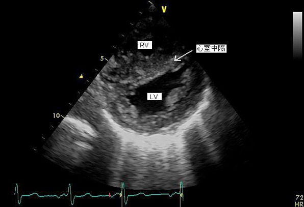 図1　心エコー　左室、右室短軸像