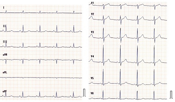 心電図2 洞調律時
