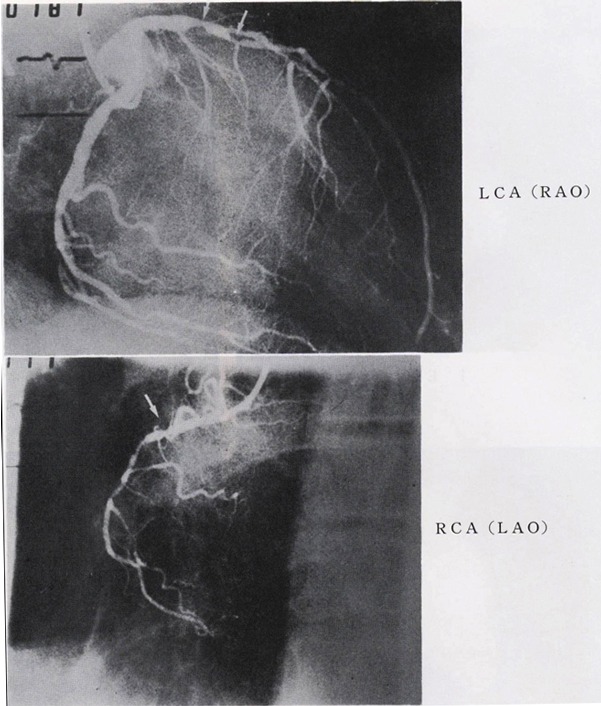 冠動脈造影図