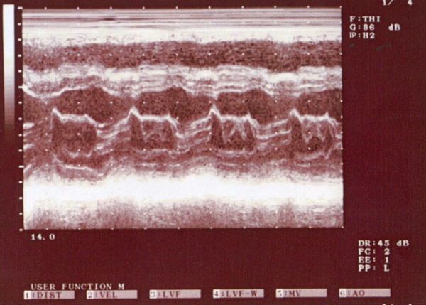 心エコー図