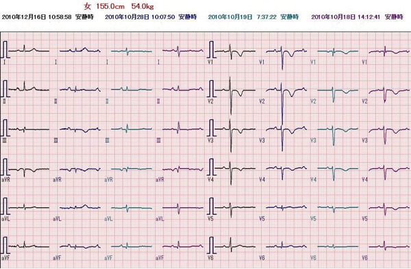 心電図の経過