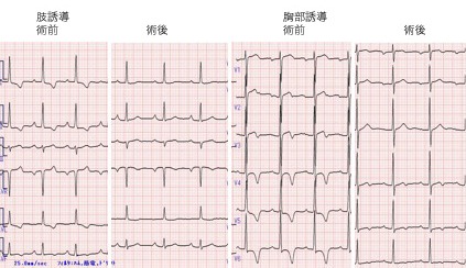 術前、術後の心電図
