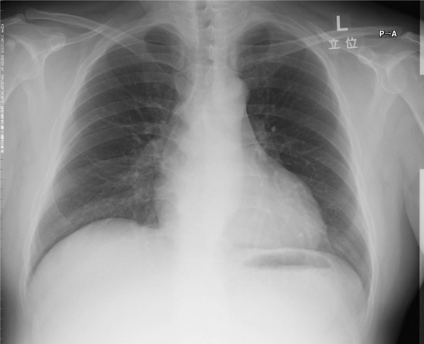 画像：10ヶ月後の胸部X線