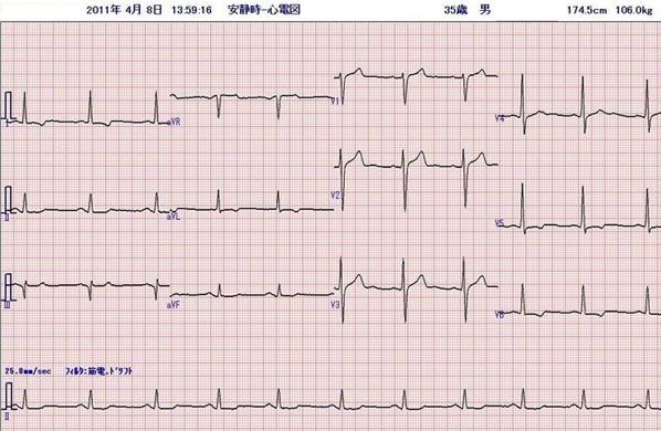 画像：10ヶ月後の心電図