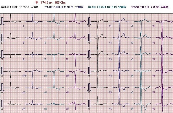 画像：心電図の経過