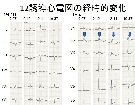 12誘導心電図の経時的変化