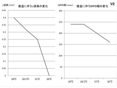 J波高、QRS幅の変化