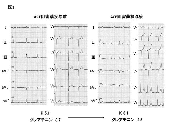 心電図　ACE阻害薬投与前後の比較