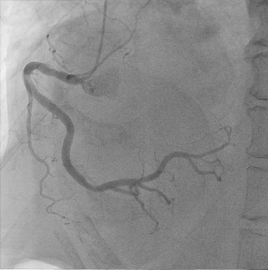 冠動脈造影　図2