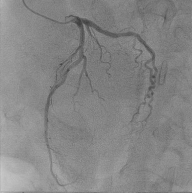 冠動脈造影　図3