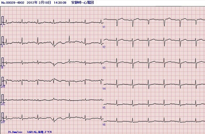 入院時の心電図