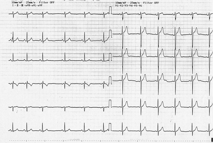 症例53 検診時に確認された心電図 公益社団法人 臨床心臓病学教育研究会 ジェックス