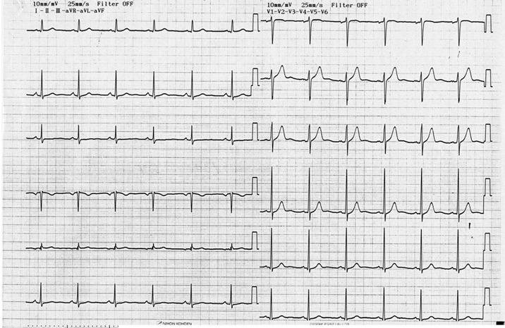 症例53 検診時に確認された心電図 公益社団法人 臨床心臓病学教育研究会 ジェックス