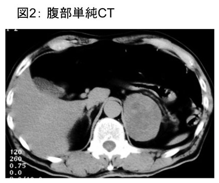 図2　腹部単純CT