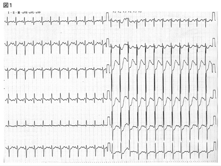 図1 59歳　男性　心電図