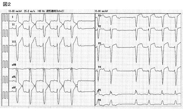 心電図2 入院後