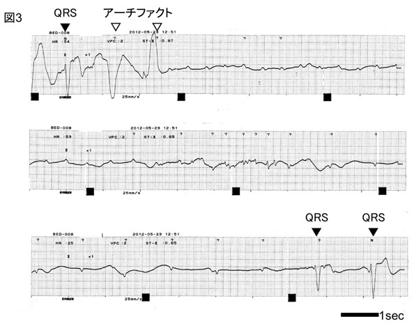 心電図3　モニター心電図