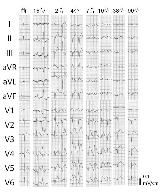  たこつぼ型心筋症　心電図の変化