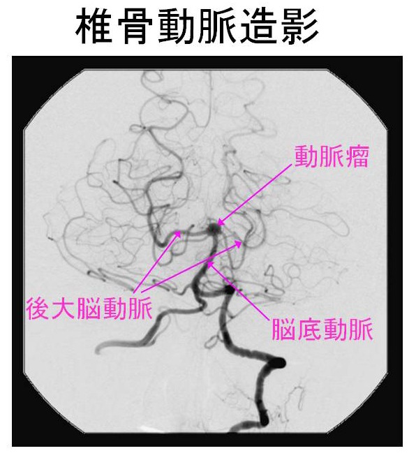 椎骨動脈造影