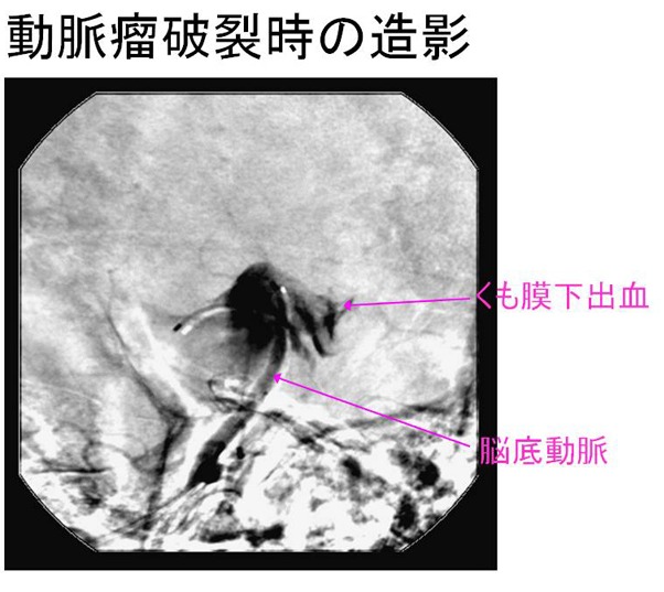 動脈瘤破裂時の造影